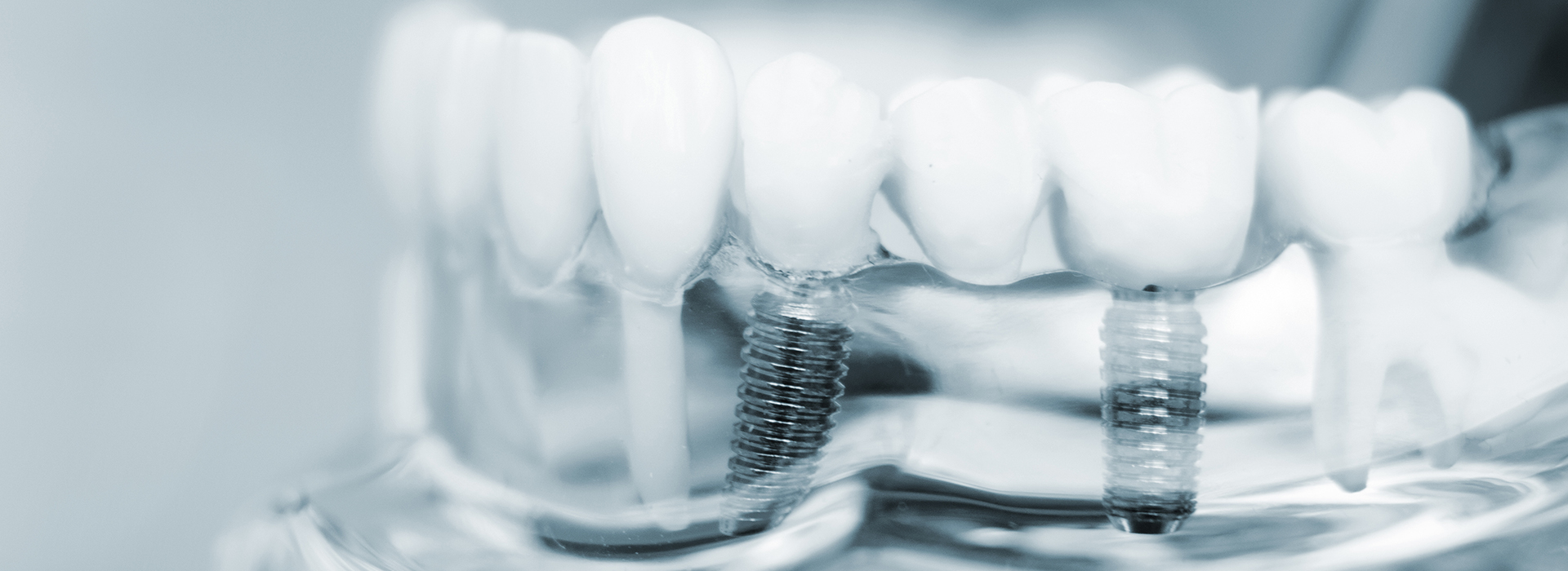 The image shows a close-up of multiple teeth with braces, set against a blurred background that appears to be a dental office setting.