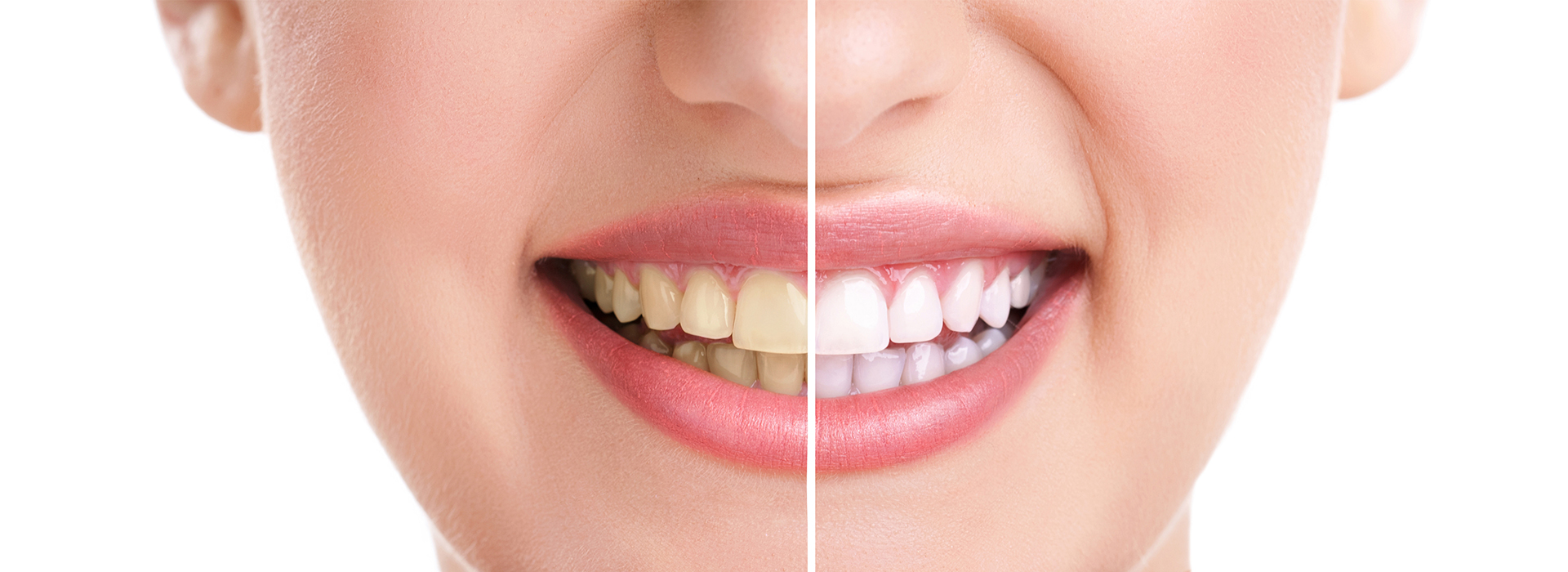 A close-up of a person s face with a focus on their teeth and smile, showcasing dental health or cosmetic treatments.